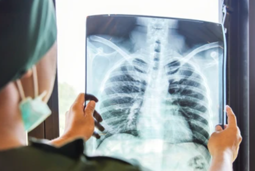 Pemeriksaan Radiologi dan Kaitannya dengan Pemantauan Kesehatan Paru
